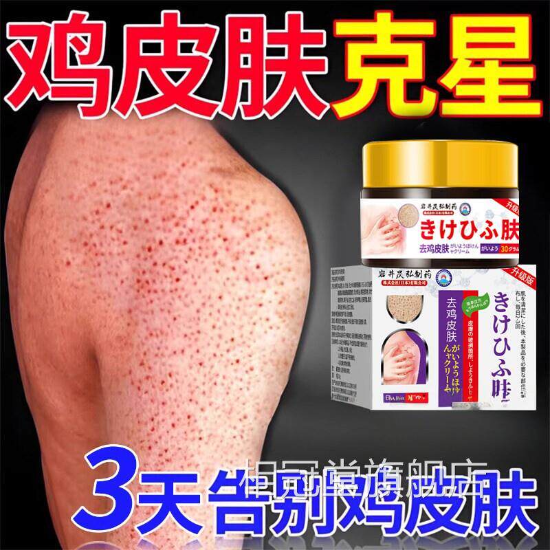 日去鸡皮肤鱼鳞疙瘩毛囊角化症本角质膏用手臂身体去除器永相冠堂
