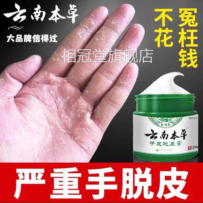 手足脱皮膏手指上真菌蜕皮干燥起童手掌蜕皮手心手足掉皮褪专皮用