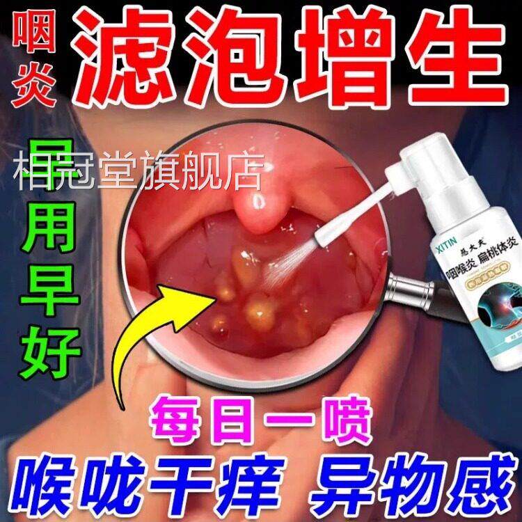 疗喉咙滤泡增生后壁治淋巴慢性咽炎咽喉炎根专慢性咽炎除用喷剂相