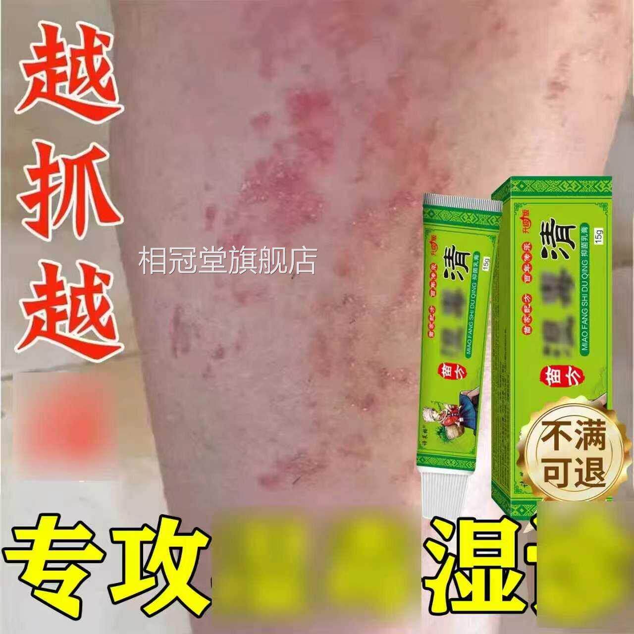 肚子肚皮围红斑专用除湿止痒膏皮肤止痒去外用周顽固皮炎根相冠堂