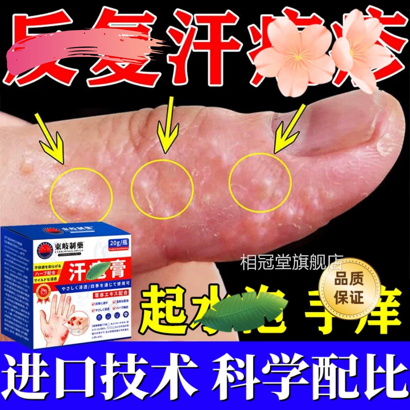 上起小水泡汗状疱痒疹带状真杀菌感染止湿手气脱皮痒专去手疹用膏