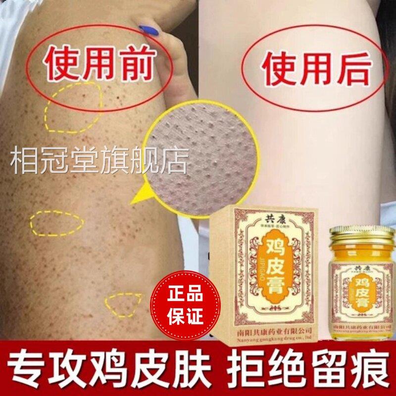 鸡皮肤上疙瘩毛囊角化症去除神器全身手臂腿专改善胳膊长疙瘩用膏