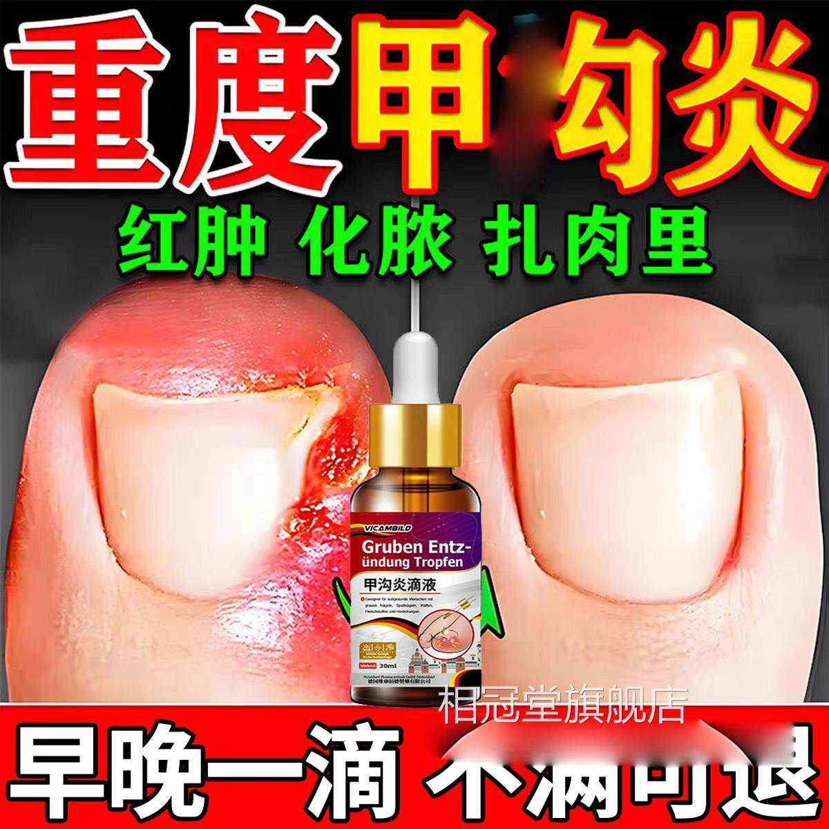 甲夹沟炎辅助治疗专用效特大药房器神脚趾根甲往肉里长手国指膏嵌