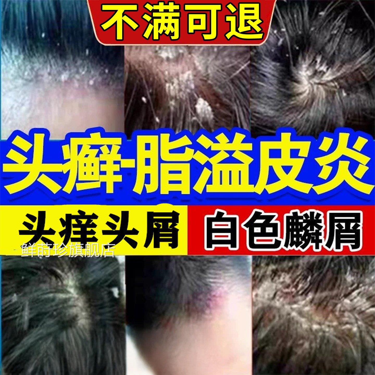 煤焦洗剂油去屑止痒脂溢性皮洗发水毛囊炎头癣真菌感染控油鲜莳珍
