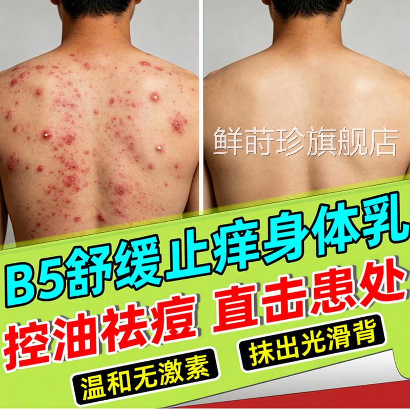 马拉色菌前胸后背部祛痘过氧化苯甲酰身体乳粉末黑印涂身体抹乳膏