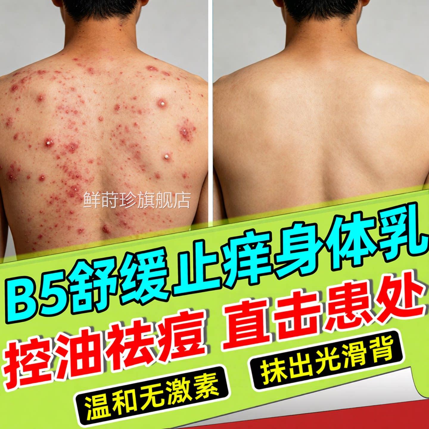 马背拉色菌前胸后部祛痘过氧化苯甲酰粉末黑印身体乳涂抹身体乳膏