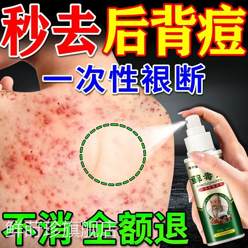 后背祛痘喷雾除前胸背上痘痘螨虫毛去囊炎疙瘩痤疮止痒效特喷剂药