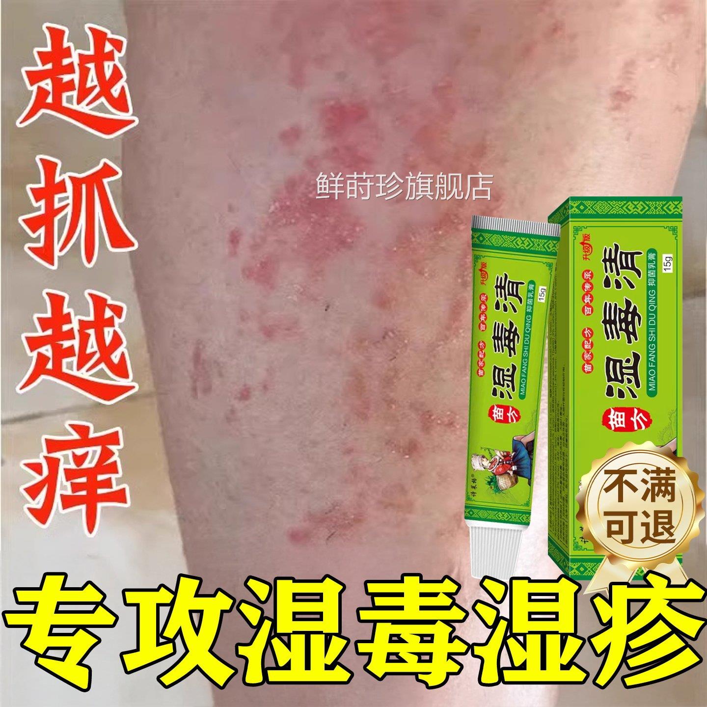 湿毒清软膏湿疹热疹止湿痒祛根皮肤皮炎瘙痒痒水泡治疗除湿专用膏