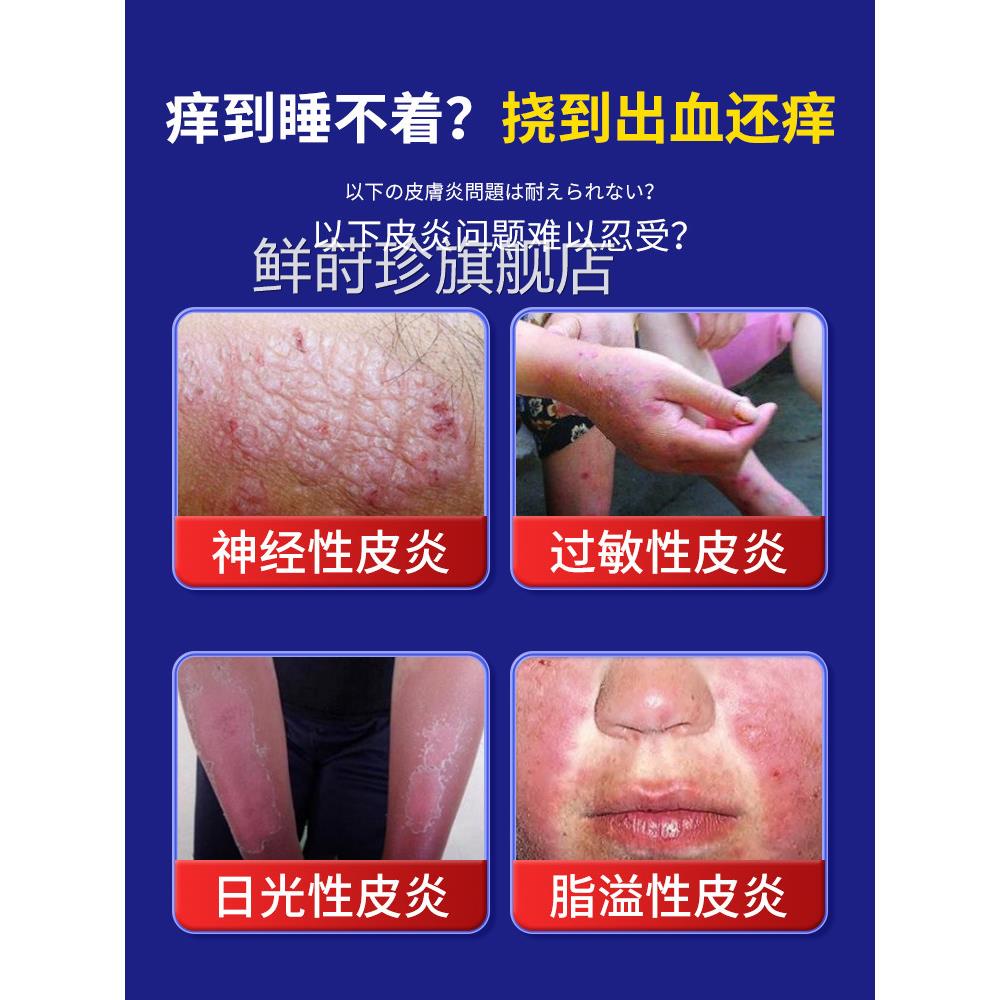 日本顽固神经性皮炎去除用膏无激素皮肤瘙痒止痒癣藓真菌外感染疹