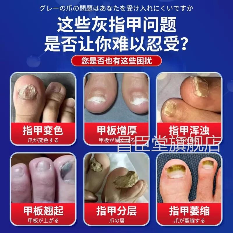 灰指甲日本进口技术水灰趾甲修复脱甲增厚空甲一正品滴抑菌净液QT