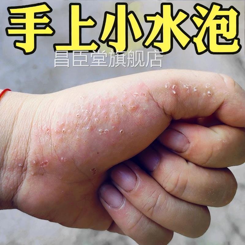 手上起小水泡汗疱疹湿痒红疹脱去汗状疱疹外用顽固皮皮炎软药膏根