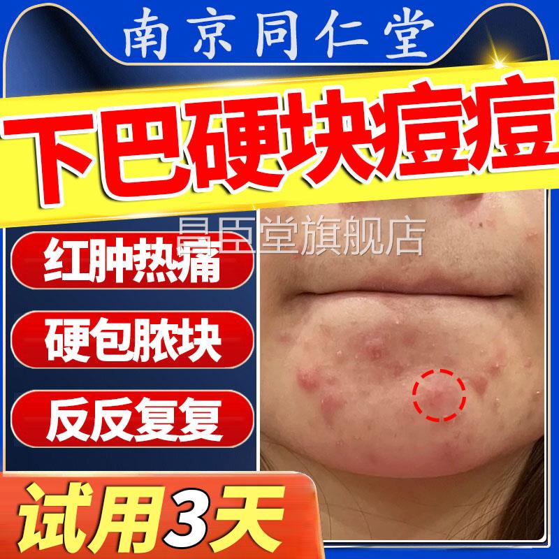 下巴反复脸颊两边长痘内分泌理失调脓包痤疮搭调火疖子膏儿童LL昌