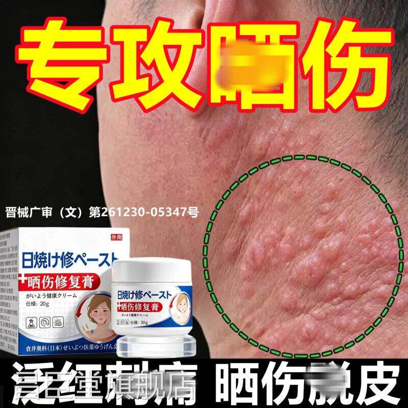 日光性皮炎紫外线过敏晒伤修复膏太光晒伤专用皮阳肤发痒乳膏正品