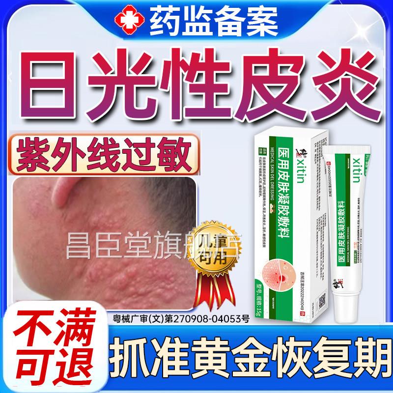 日光性皮炎特效紫修外线过敏复霜专用膏医太阳晒伤皮肤发痒神经PP
