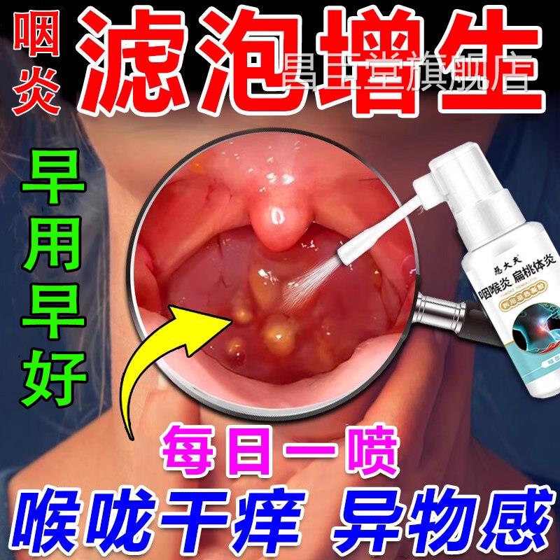 治疗喉咙滤泡增生后壁淋巴慢性咽炎咽除喉炎慢性咽炎根专用喷剂LL