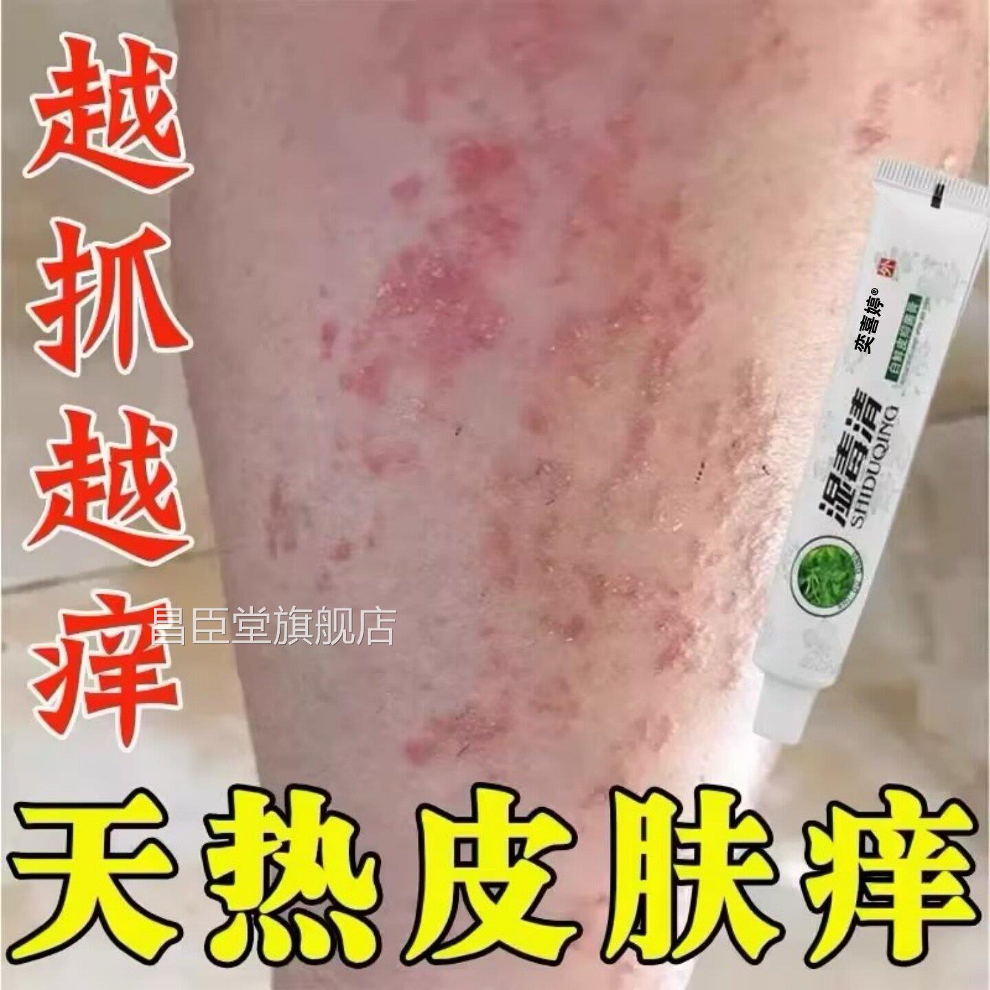 夏天小出腿痒湿成人止膏汗身上痒天热皮肤疹瘙痒热疙瘩红疹热毒痒
