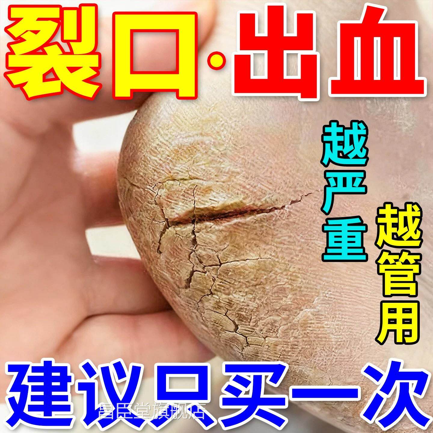 日修本脚后跟干裂复霜滋润脚底开裂脱皮起硬皮防护手足裂口皲裂膏