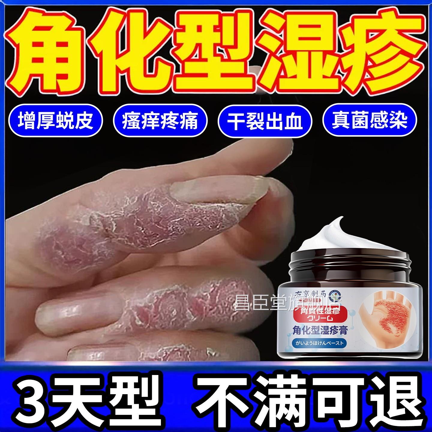 角化型脚湿疹手部脱皮干裂真菌感染止痒专用手足癣去手根部止痒膏