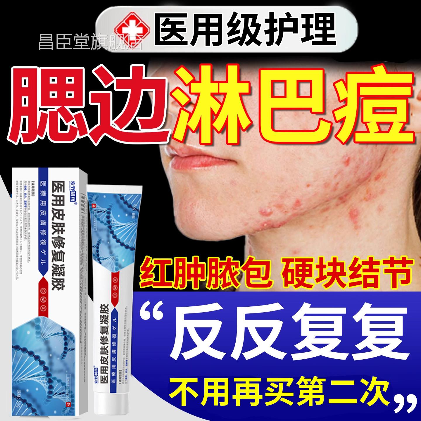 淋巴腮边痘下巴反复长痤疮痘痘下颚线瘩硬块脖子毛疙囊炎软膏Y7昌