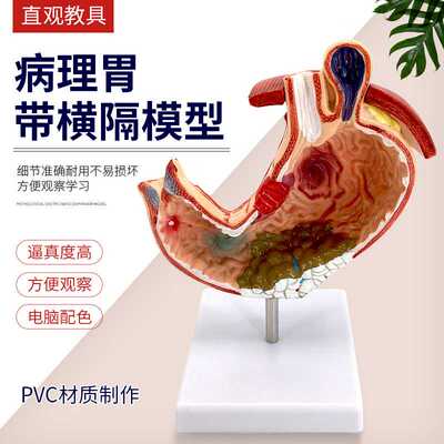教学仿真病态胃模型病理胃解剖模型内脏解剖标本人体解剖病变模型