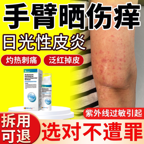 【手臂日光性皮炎】dr.avin旗舰