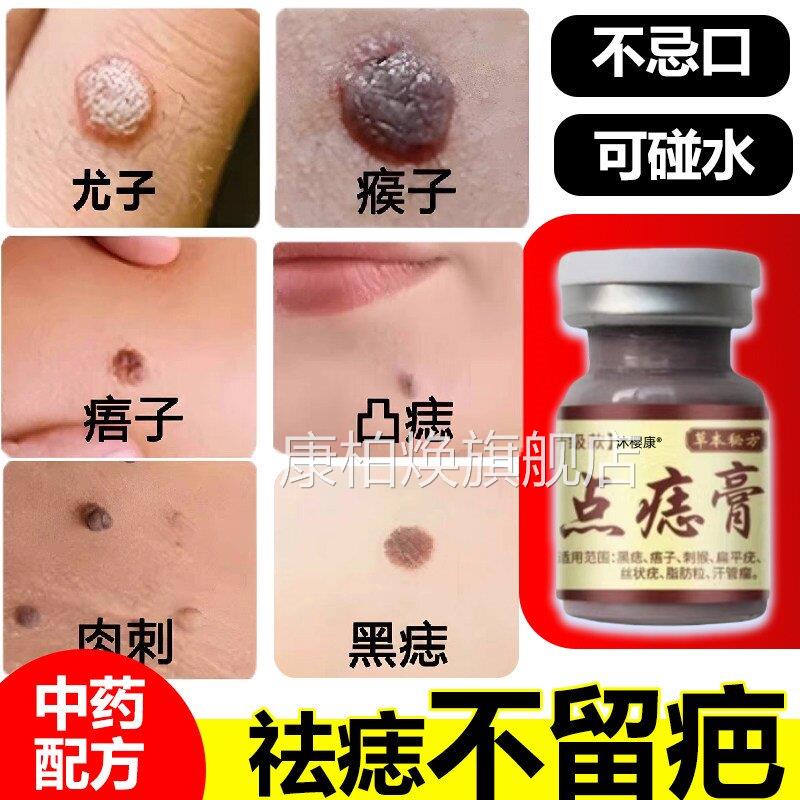 点痣痦子膏去脖子小肉粒尤猴去除抑祛菌液腋下皮扁平尤丝状尤康柏