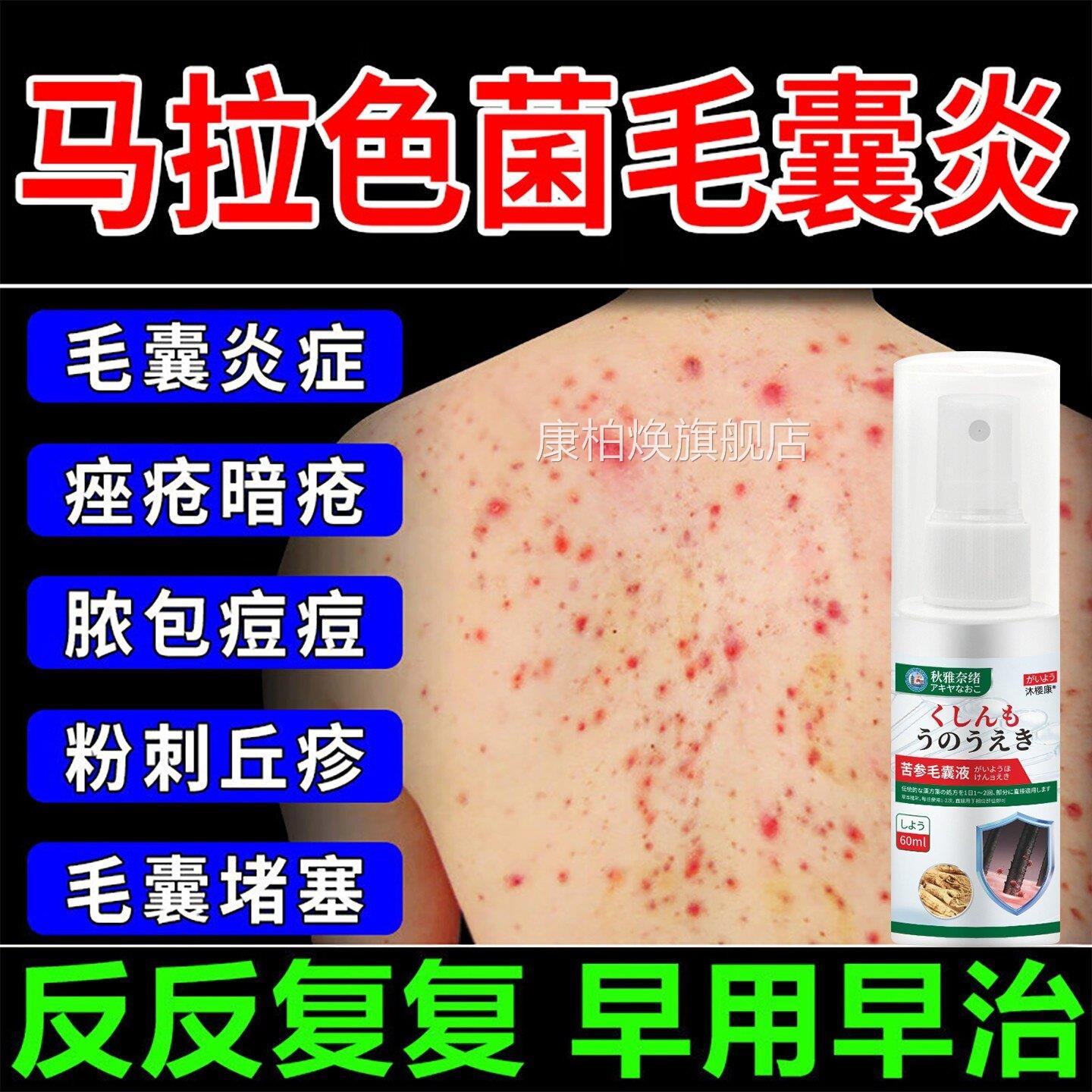 毛囊炎喷剂前胸后背马拉色菌毛囊炎瘙痒红痤疮疙肿瘩真菌感染痘痘