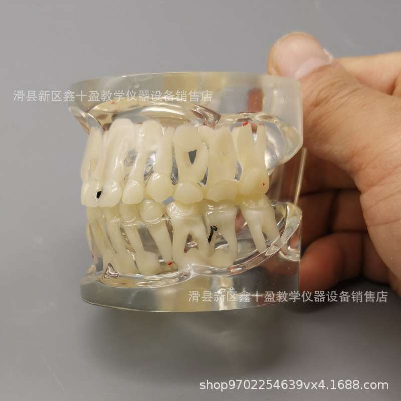 儿童病理模型 乳恒牙交替带龋坏蛀牙齿水晶透明牙齿模具 乳牙列