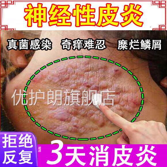 神经性皮特药效根去外用膏治疗除皮肤炎病癣藓湿疹真菌感染顽固W
