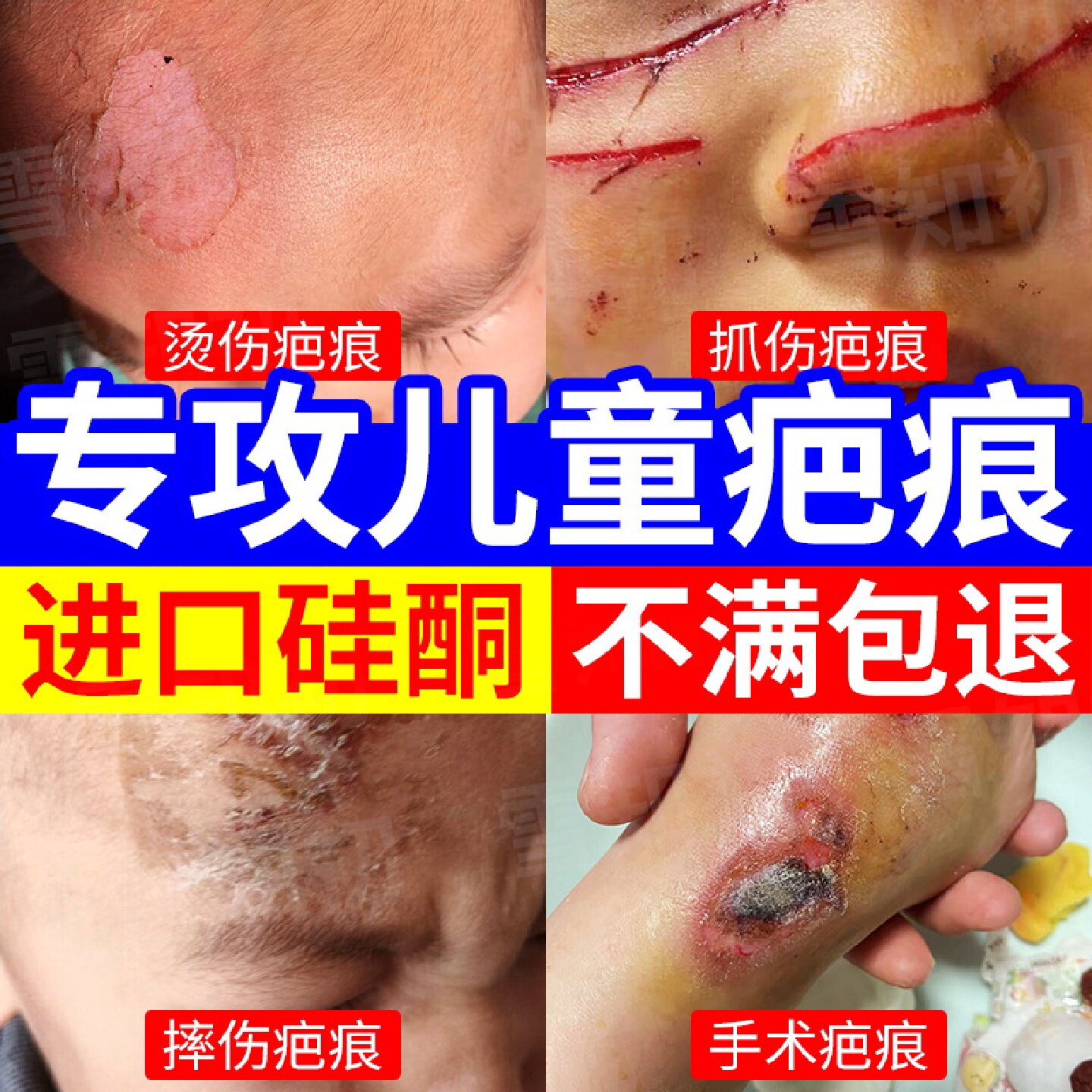 祛疤膏儿童专用小孩烫伤摔伤去除手术疤痕黑色素医用进口硅酮旗舰