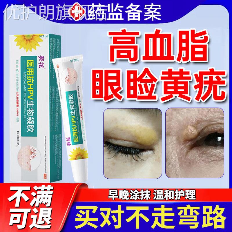 眼睑黄瘤去眼皮黄斑瘤黄疣专用膏眼部脂肪粒睑黄疣眼角黄斑去除UU