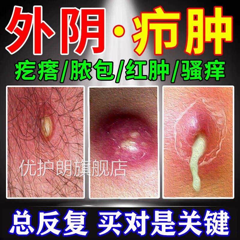 外阴疖肿拔毒膏火疖子药膏拔脓敷膏脓包硬块贴屁股上私处长有痘痘