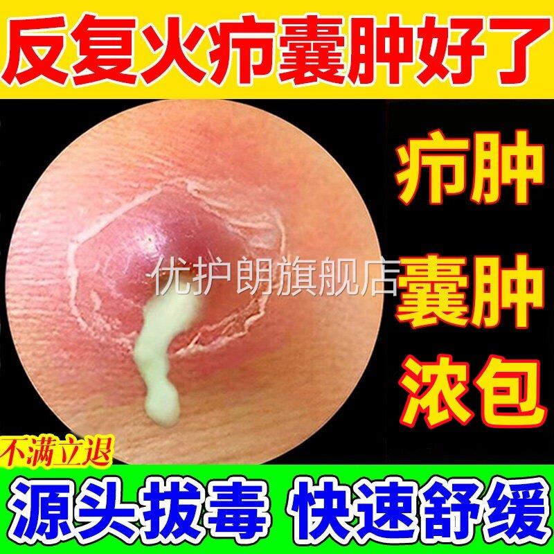 断痒拔毒膏皮脂腺囊肿火疖子膏药去除粉瘤囊肿脓贴长痘坐疮神正品