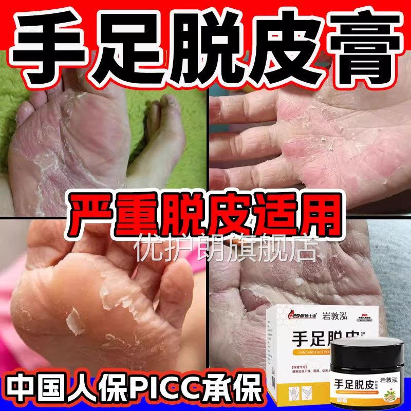 手足皮脱皮膏手指上起干燥脱皮脚底皴裂防手干裂皮肤抑菌护肤膏优