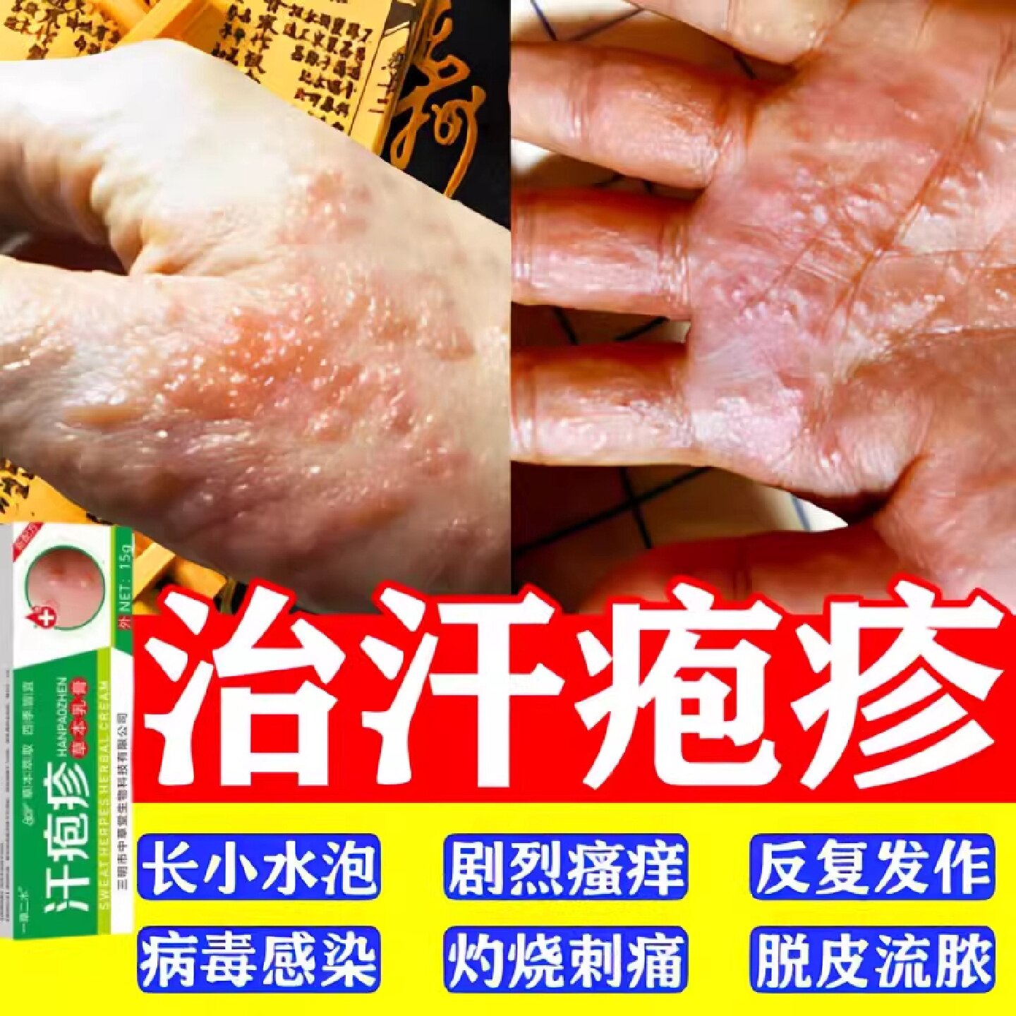 手上起小水泡汗泡疱止痒中药抑菌鹅掌风真菌感染手气湿痒旗舰店