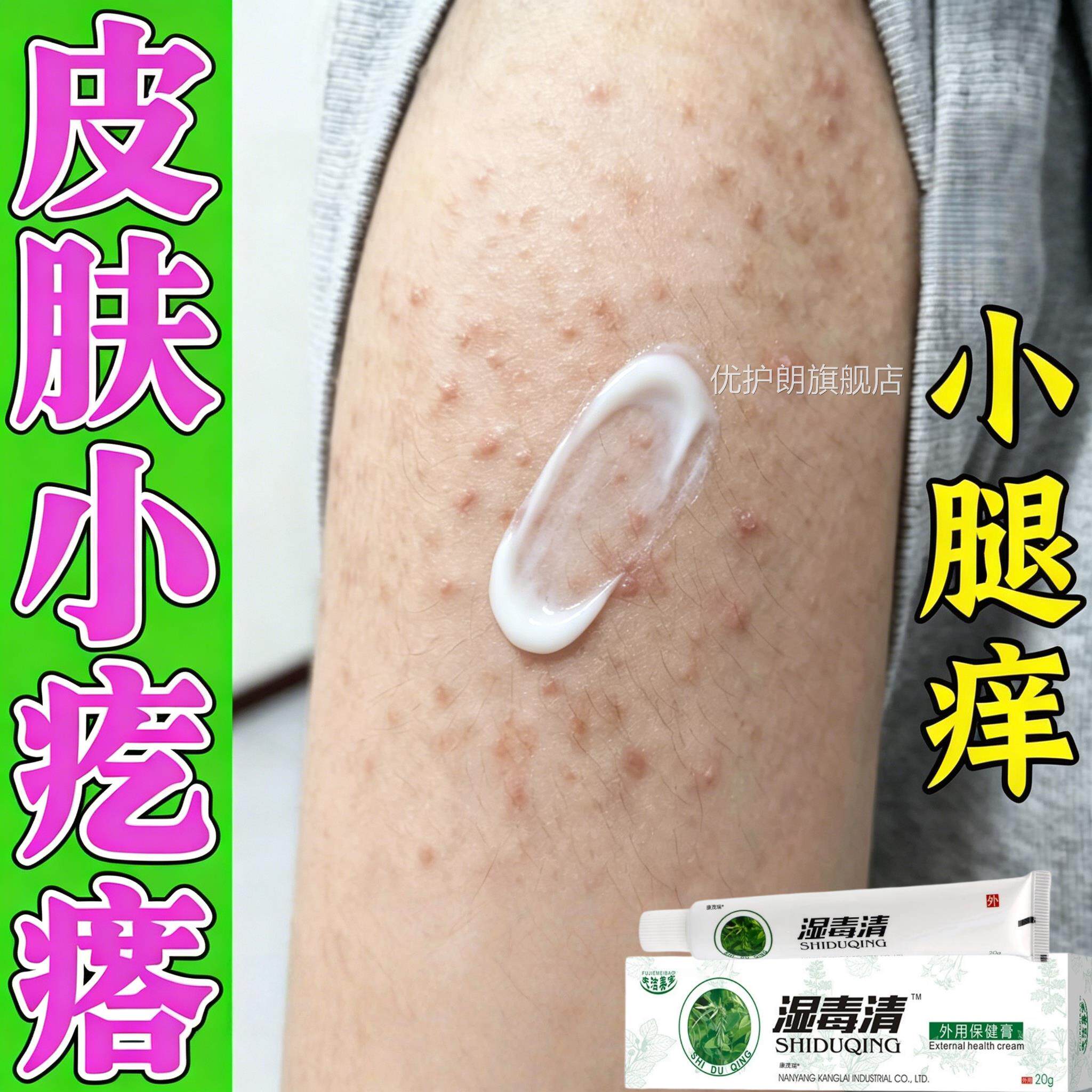 夏天小腿湿痒成人止膏出汗身上痒天热皮肤瘙痒热疙瘩红疹热毒优护