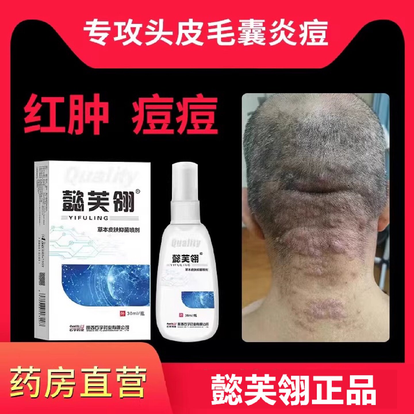 懿芙翎康光3号三号喷剂马拉色菌1丹马色拉菌毛囊炎喷雾头皮专用旗