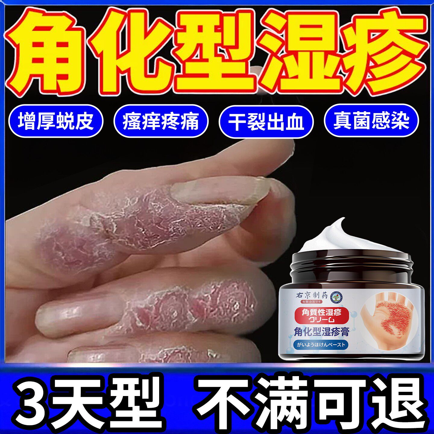 角化型湿疹手部脱皮干裂真菌感染止痒专用手足癣去手脚根部止旗舰