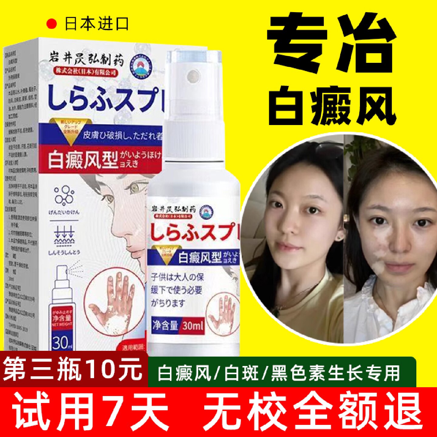 进口白癜风药膏提高免疫力外用快速消白斑黑色素生长神器遮旗舰店