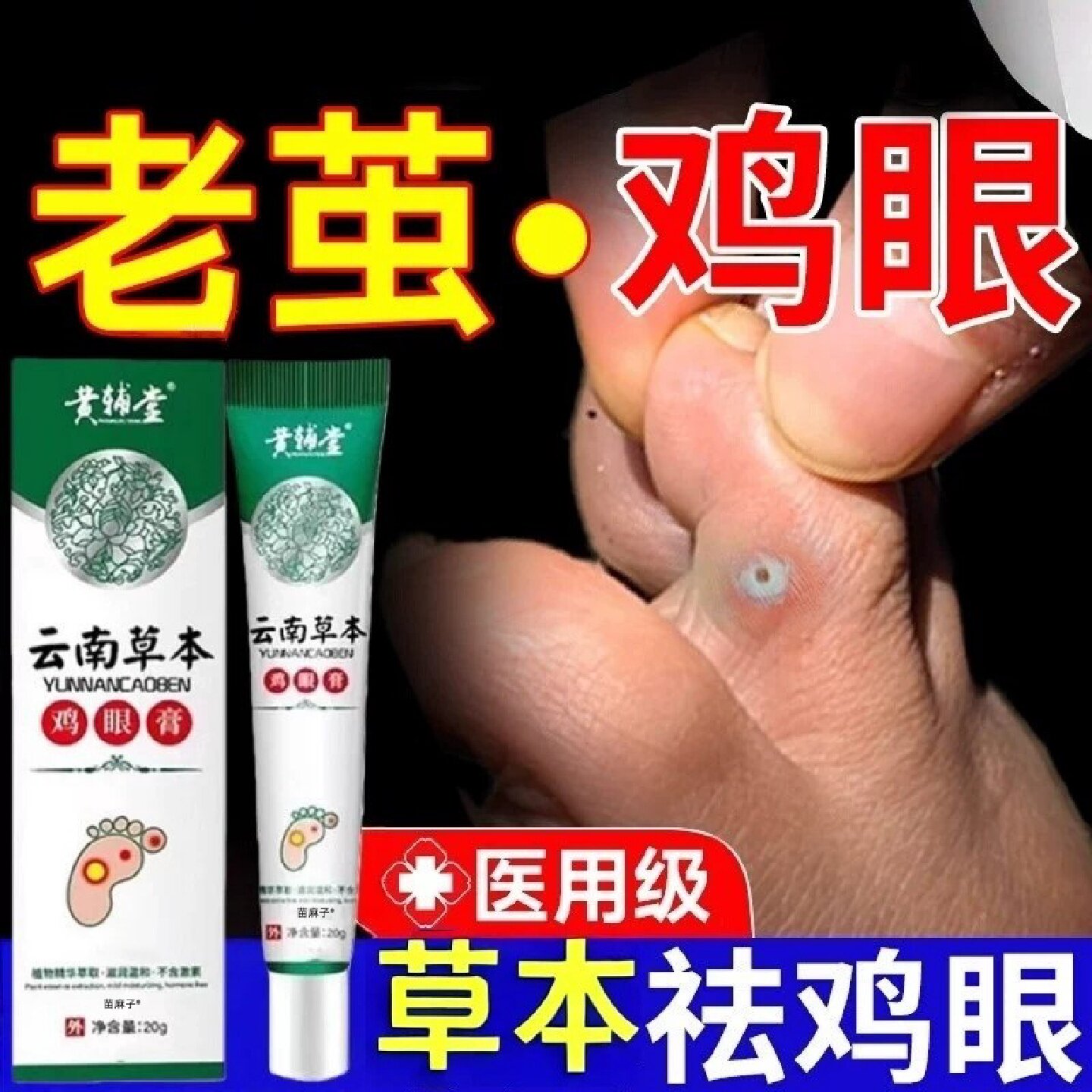 鸡眼贴除根专用祛治疗脚鸡眼膏特官方医用级正品膏水水旗舰店