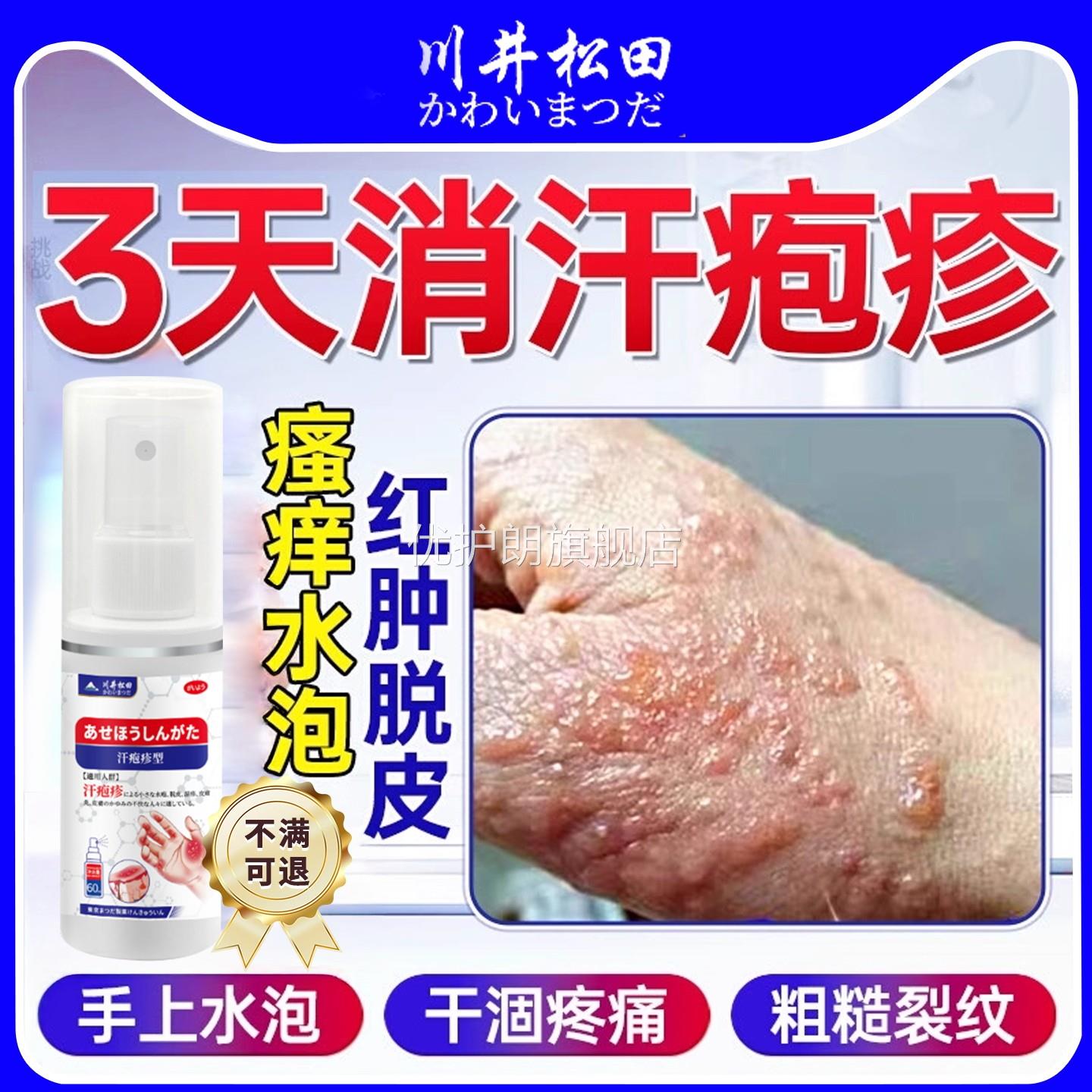 汗疱疹去手上起小水泡汉汗状真菌感染专用软膏干裂脱皮痒根抑菌优