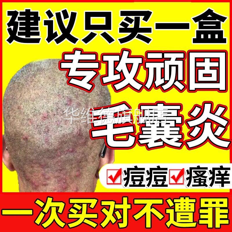 马拉色菌头皮毛囊炎头部专用头上长痘痒有疙瘩非药特效脂溢性皮炎