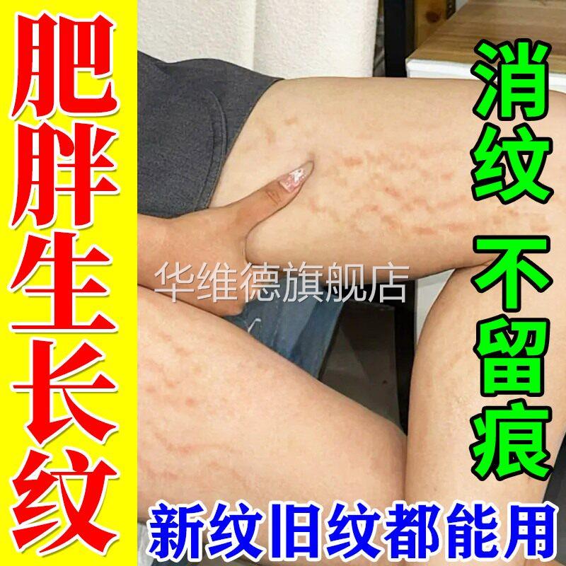 去除肥胖纹青少年专用学生消除大腿生长纹修复霜紧致肚皮去妊娠纹