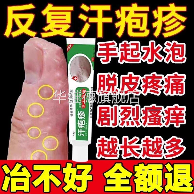 汗泡疱疹药膏手上起小水泡汗状疱疹止痒真菌感染汗泡湿疹用专软膏