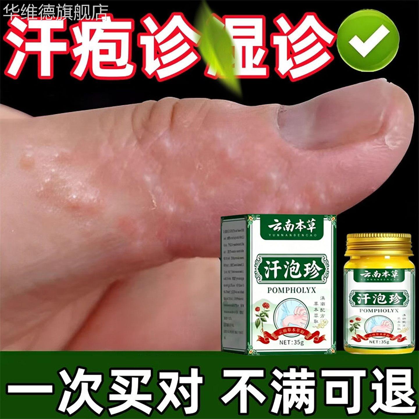 汗泡疱疹手上起小水泡疱疹止汗状真感专菌手气非痒脱皮染湿疹用膏