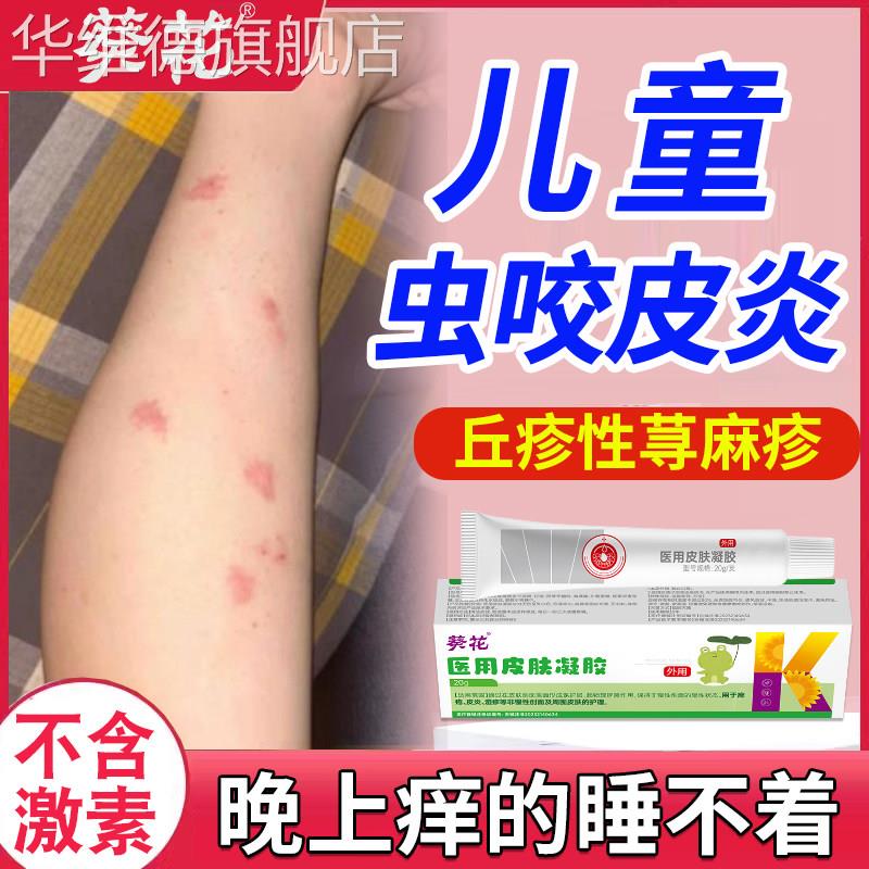 虫咬性皮炎丘疹性荨麻疹药监备案过敏止痒断软膏儿童根寻荨麻疹华