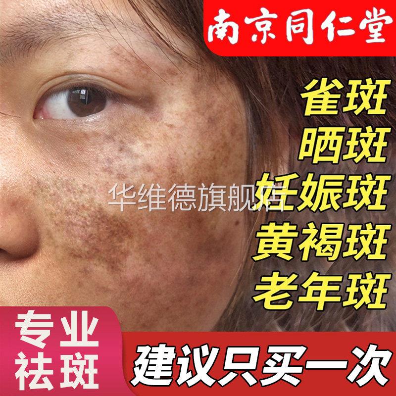 美白祛斑霜纯中药去斑正品官方旗舰店草本祛黄早晚淡化色斑名华维