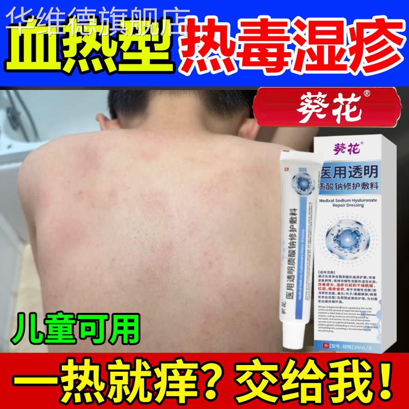 葵花热毒湿疹止痒膏皮肤一热就痒苗医苗方热痱子热疹天气热皮肤痒