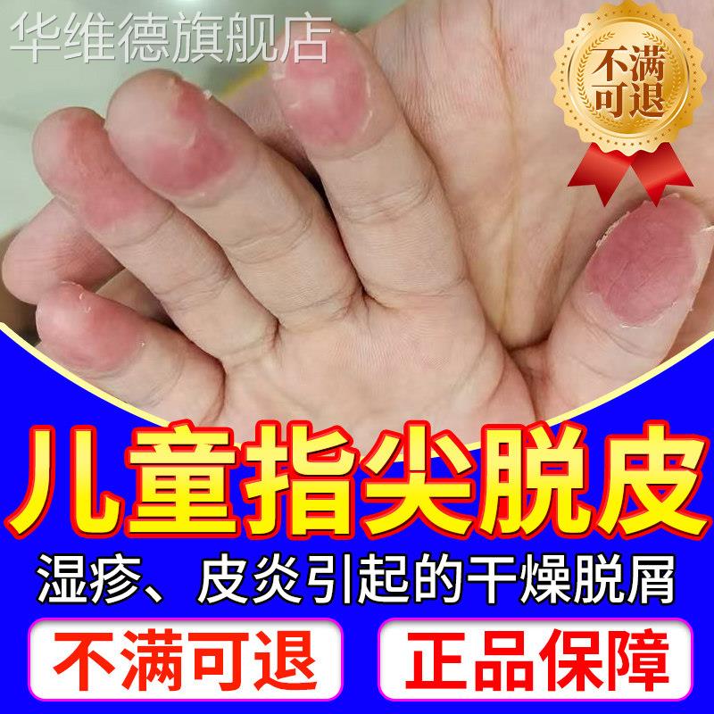 手指脱皮指尖专用儿童手癣膏脱皮干裂真菌感染严重蜕皮干燥起皮LL