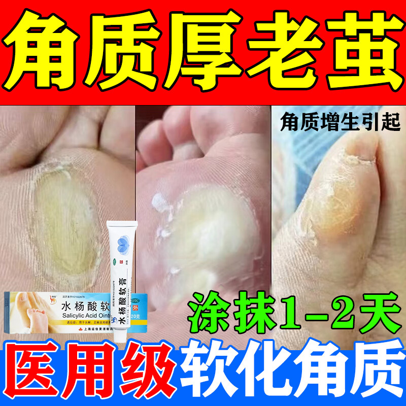 水杨酸软化角质软膏官方旗舰正品医用鸡眼去脚老茧死皮角质软化剂
